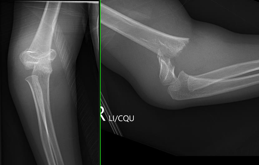 Supracondylar Fracture The Bone School